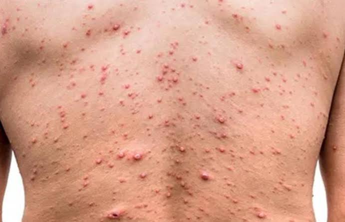 Monkeypox: Primeiro caso é confirmado em Juazeiro
